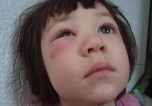Аллергический отек глаз у ребенка