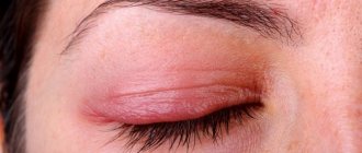 Аллергия на глазу