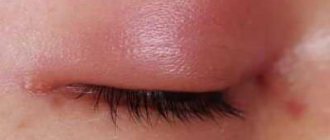 Allergy to eyelash extensions