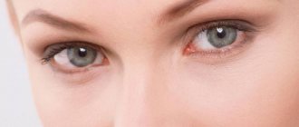 Allergies around the eyes