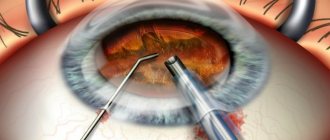 Артифакия глаза