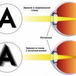 eye astigmatism