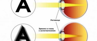 астигматизм глаз