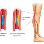 Атеросклероз сосудов ног