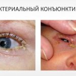 Бактериальная форма