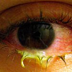 Бактериальный (гнойный) конъюнктивит глаза