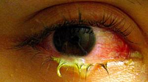 Бактериальный (гнойный) конъюнктивит глаза