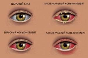 Бактериальный конъюнктивит глаз. Симптомы, лечение у детей, капли