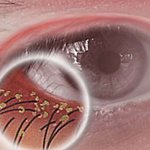 Блефароконъюнктивит глаз - острый и хронический