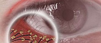 Блефароконъюнктивит глаз - острый и хронический