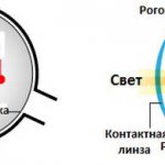 Близорукость (миопия) - контактные линзы