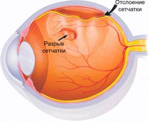 Болит глаз после операции по отслойке сетчатки глаза