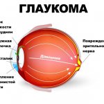 headache, blurred vision