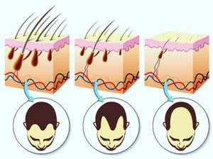 Частичное или полное выпадение волос на голове, лице и на др.участках тела