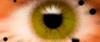 Black dot on the eyeball