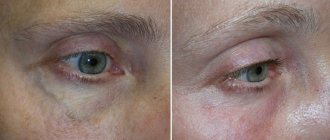 What are varicose veins of the eye?