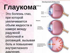 Что представляет собой глаукома