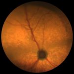 Что такое атрофия сетчатки глаза