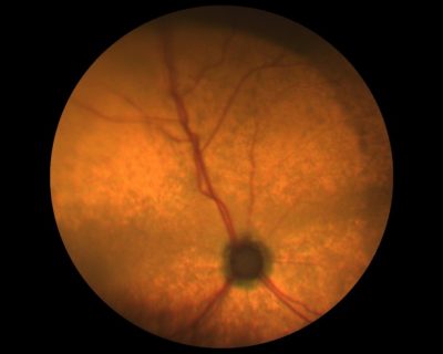 Что такое атрофия сетчатки глаза