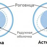Что такое гиперметропический астигматизм - сложный и простой