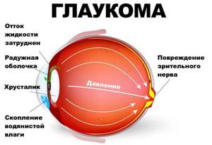 Что такое глаукома