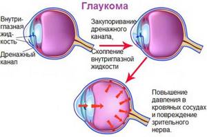 Что такое глаукома