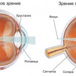 Farsightedness - is it a plus or a minus?