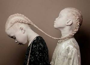 дети альбиносы