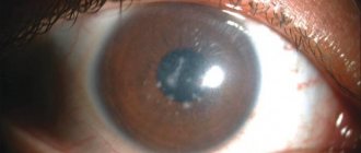 дистрофия глаз