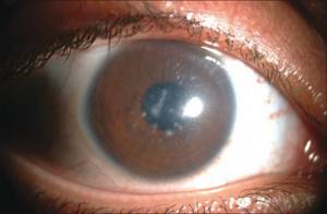 дистрофия глаз