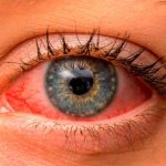 Is tetracycline ointment effective for conjunctivitis? rules for using the drug 