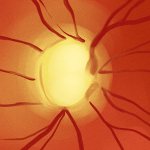 Экскавация диска зрительного нерва (ДЗН)