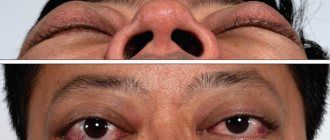 Эндокринная офтальмопатия