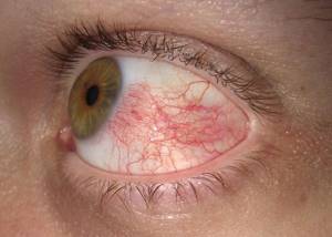 Эписклерит глаза: причины, симптомы и лечение заболевания препаратами детей и взрослых, код мкб-10