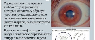 Epithelial form of keratitis