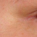 photo of eye conjunctivitis