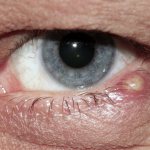 фото ячменя глаз
