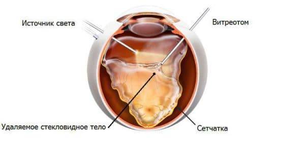 Гемофтальм: лечение и причины кровоизлияния в стекловидное тело