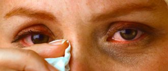 Herpes on the skin of the eyes