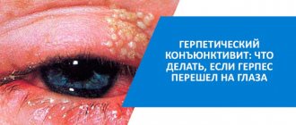 герпесный конъюнктивит