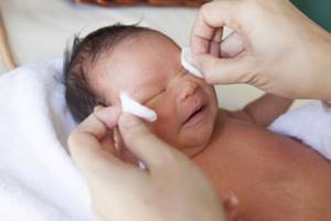 Гигиенические процедуры и закапывание сульфацила натрия - обязательная профилактика гонобленнореи новорожденных