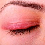 гиперемия и опухоль краев век