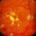 Hypertensive retinal angiopathy ICD code