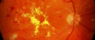 Гипертоническая ангиопатия сетчатки глаз код по мкб