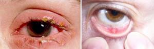 Глазной хламидиоз: как правильно выбрать глазные капли от хламидиоза?