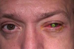 Гноится и болит глаз после операции по удалению катаракты