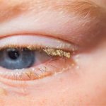 Гнойный конъюнктивит глаз у детей