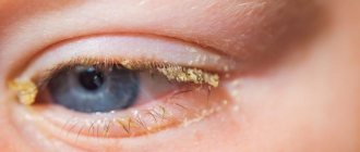 Гнойный конъюнктивит глаз у детей