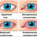 Гомеопатические глазные капли - список лучших, отзывы