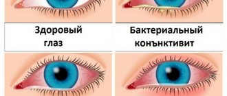 Гомеопатические глазные капли - список лучших, отзывы